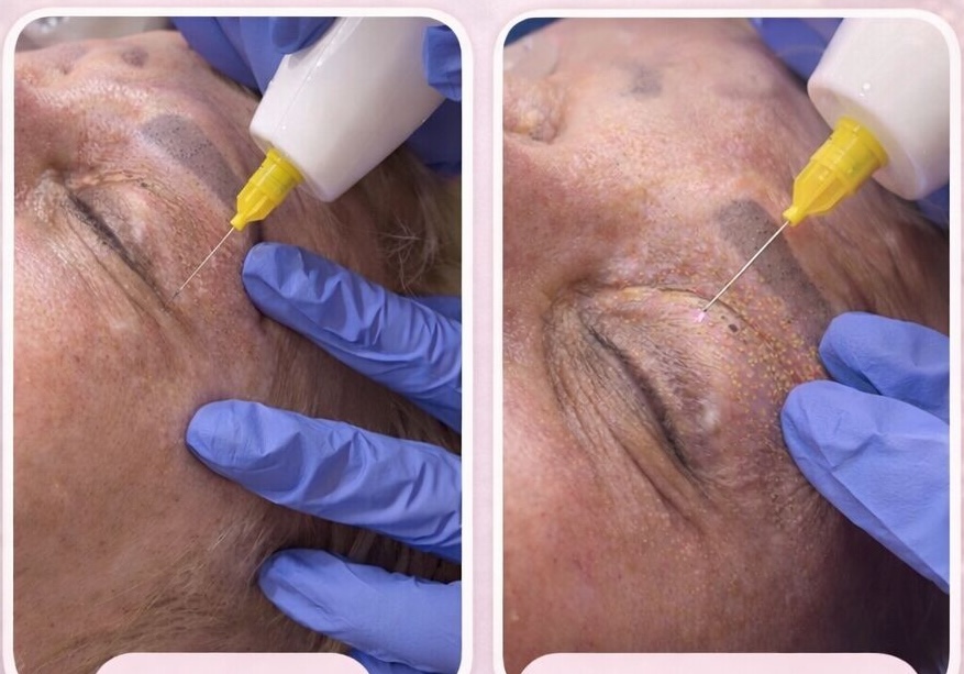 Plasma pen fibroblast eye area treatment before and after