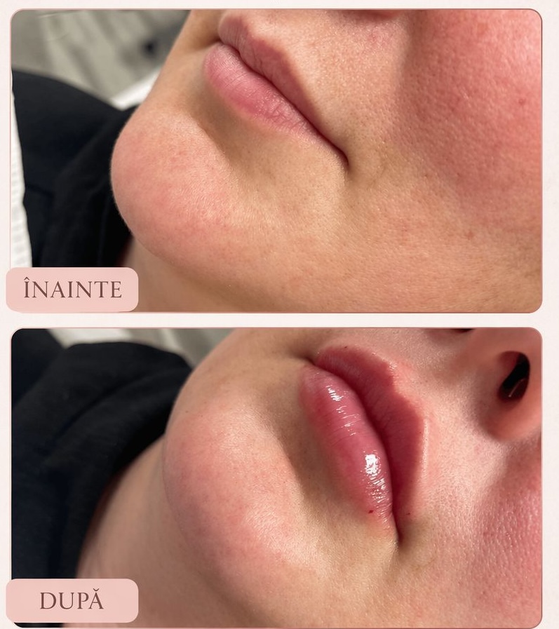 Lip filler before and after