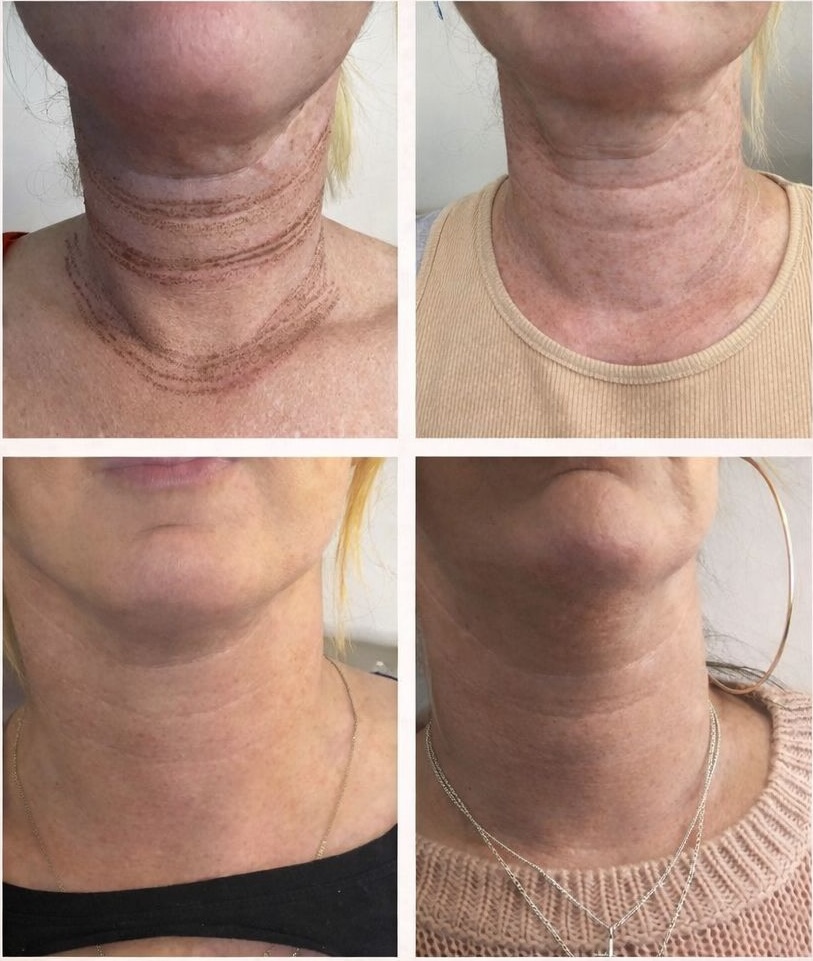 Plasma pen neck rejuvenation before and after