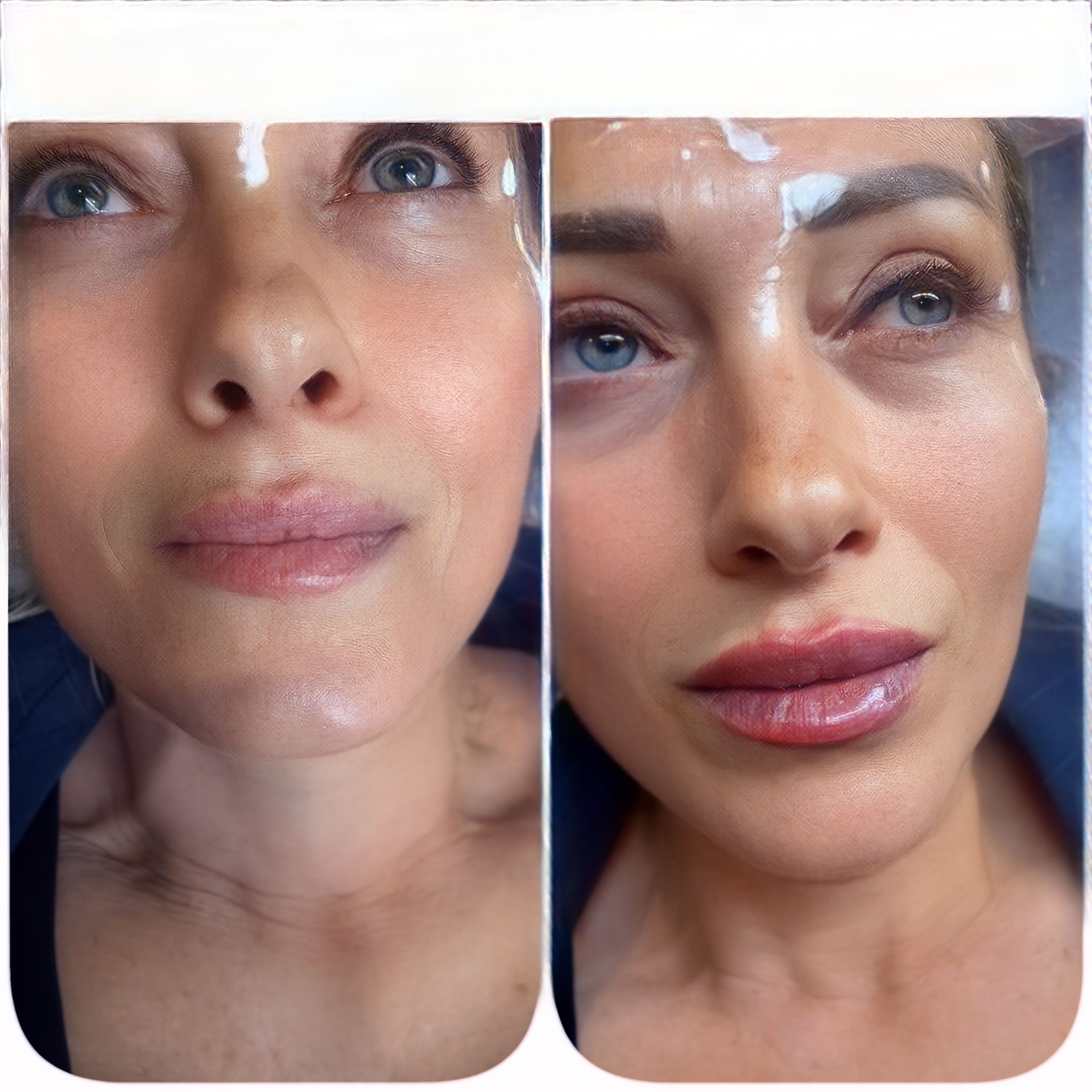 Full face aesthetic treatment before and after