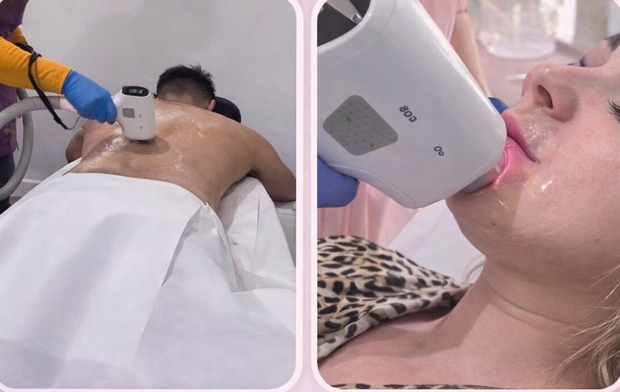 Laser hair removal session