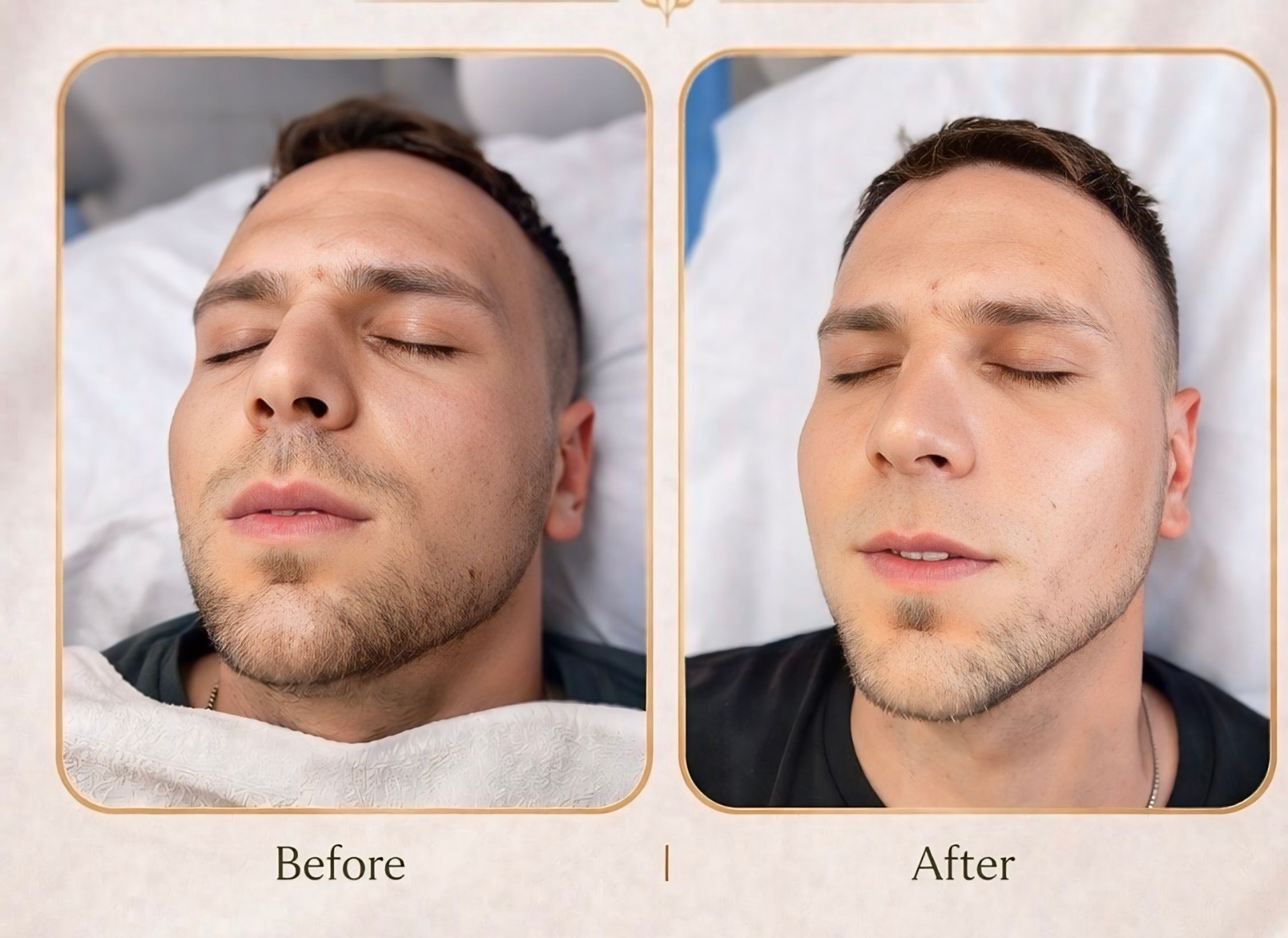 Facial treatment for men before and after